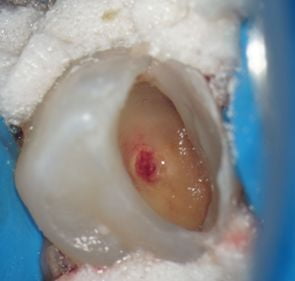 Contrôle de la douleur en endodontie